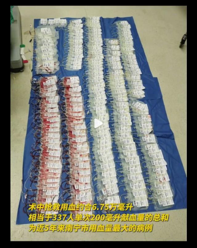 产妇羊水栓塞输血超6万毫升被救 羊水栓塞是什么原因引起的？